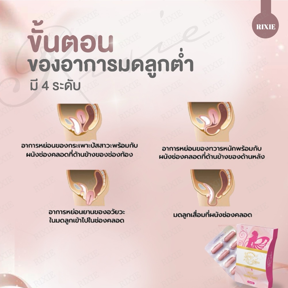 มดลูกหย่อน